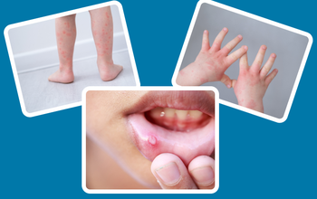 Những dấu hiệu khỏi bệnh tay chân miệng và cách chăm sóc trẻ sau khi khỏi bệnh