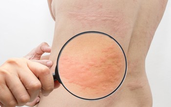 Giao mùa bị nổi mề đay nên làm gì để giảm ngứa mề đay nhanh tại nhà?
