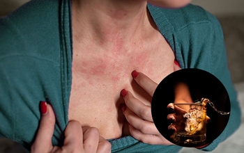 Nổi mẩn ngứa sau khi uống rượu bia có nguy hiểm không? Có phải dấu hiệu gan kém?