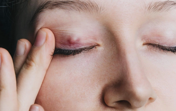 Nổi u trên mí mắt: Dấu hiệu ung thư hay bệnh lý khác?
