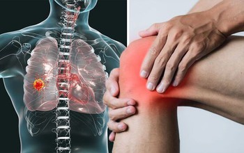 Ung thư phổi trẻ hóa, ghi nhớ ngay cách nhận biết 4 dấu hiệu ung thư phổi ở chân dễ bị bỏ qua