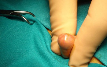 Tổng quan về thao tác phẫu thuật cắt bao quy đầu nam giới nào cũng cần biết