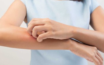 Viêm da dị ứng tiếp xúc: căn bệnh dị ứng nguy hiểm ai cũng cần biết
