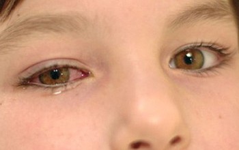 Biến chứng của bệnh thiên đầu thống có thể gây mù lòa