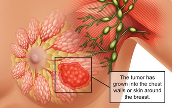 Những điều cần biết về u diệp thể ở vú