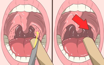 Biến chứng nguy hiểm từ bệnh viêm họng hạt mãn tính