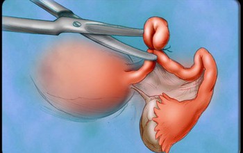 Tìm hiểu về phương pháp phẫu thuật ung thư buồng trứng 