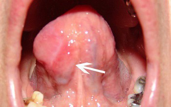 Triệu chứng ung thư lưỡi giai đoạn cuối và cách điều trị