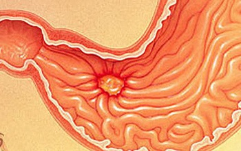 Viêm hang vị dạ dày là gì? 9 điều cần nhớ về bệnh viêm hang vị dạ dày