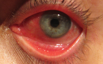 Viêm mống mắt là gì? Bệnh có nguy hiểm không?