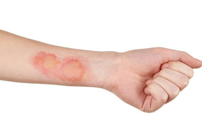 Nấm da xuất hiện trên cánh tay