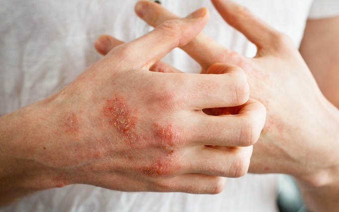 Những yếu tố nào làm tăng nguy cơ bị bệnh nấm da