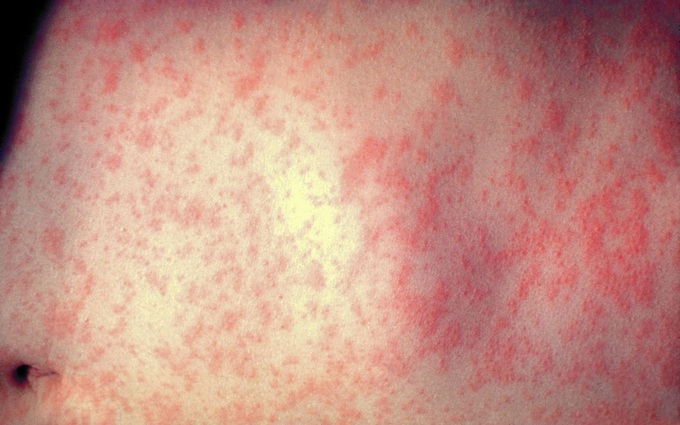 Bệnh sởi và bệnh sốt phát ban: Phân biệt bằng cách nào?