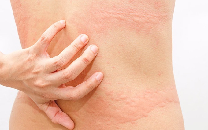 Tại sao mùa thu dễ mắc bệnh, đặc biệt các bệnh về da