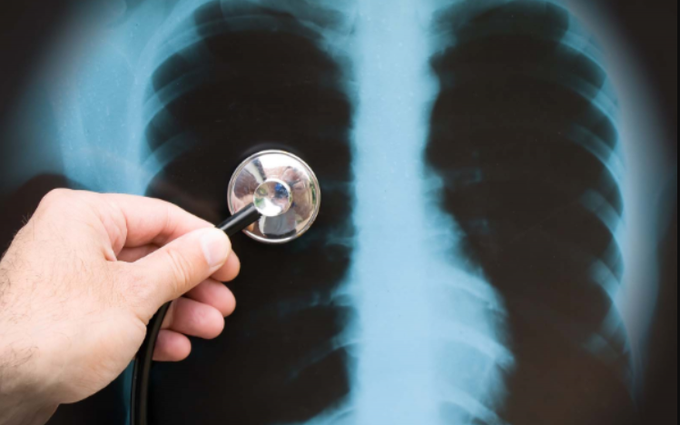 Ứng dụng X-Quang và CT-Scaner trong chẩn đoán bệnh phổi tắc nghẽn mãn tính (COPD)