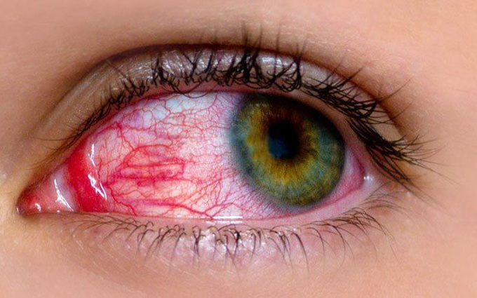 Sai lầm khi chăm sóc người bị đau mắt đỏ khiến tình trạng bệnh trở nên nặng hơn