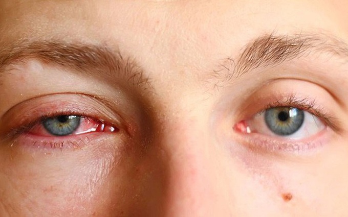 Các bệnh dễ nhầm lẫn với đau mắt đỏ: Điều trị sai cách có thể dẫn đến mù lòa