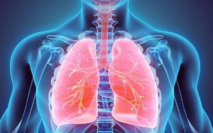 Tràn khí màng phổi: Từ A đến Z về tình trạng tràn dịch màng phổi mà bạn cần biết