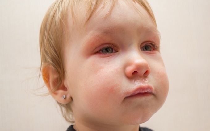 Tổng hợp các câu hỏi thường gặp về bệnh đau mắt đỏ ở trẻ nhỏ