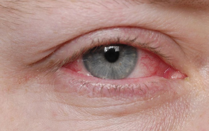 Các bước vệ sinh mắt khi bị đau mắt đỏ đúng cách để nhanh khỏi bệnh và phòng ngừa biến chứng