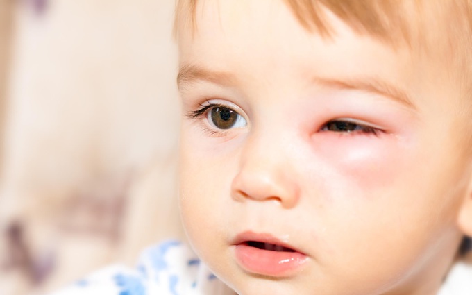 Những nguyên nhân gây bệnh đau mắt đỏ theo phân loại bệnh để phòng tránh đúng cách