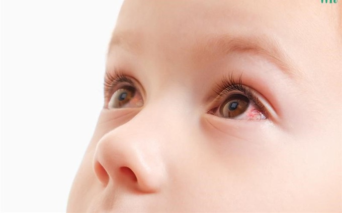 Những con đường lây nhiễm đau mắt đỏ: Nhìn vào mắt người bị đau mắt đỏ có lây không?