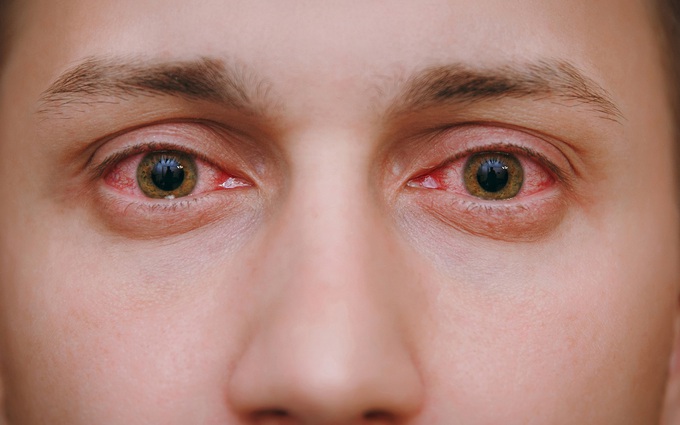 Sự khác biệt giữa đau mắt đỏ và viêm loét giác mạc không phải ai cũng biết
