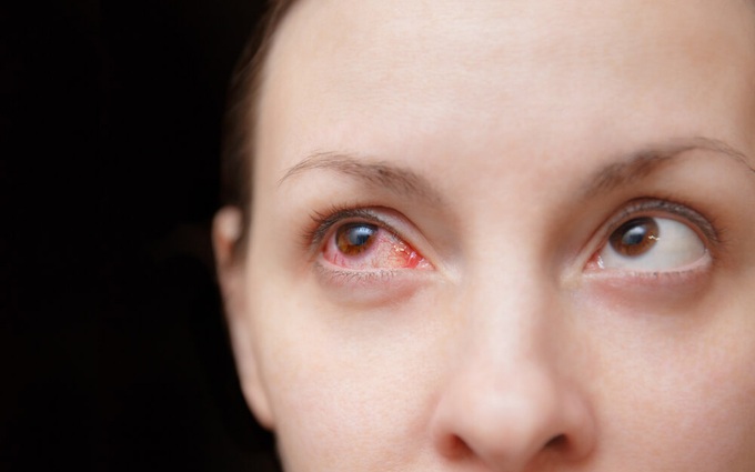 Tìm hiểu chung về bệnh đau mắt đỏ ở phụ nữ mang thai