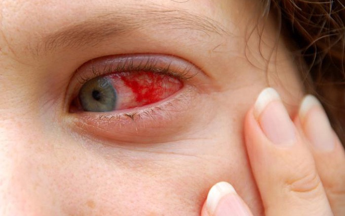 Điều trị biến chứng đau mắt đỏ: Tuyệt đối tuân thủ chỉ định của bác sĩ và không chủ quan