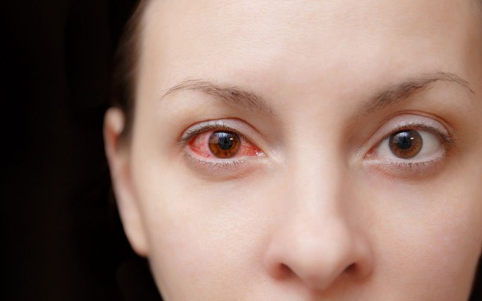 12 câu hỏi thường gặp về bệnh đau mắt đỏ (bệnh viêm kết mạc)