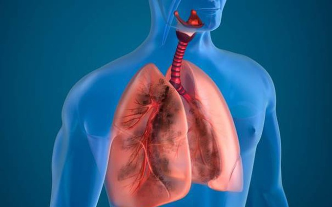 5+ hiểu lầm về bệnh phổi tắc nghẽn mãn tính (COPD) thường gặp nhất