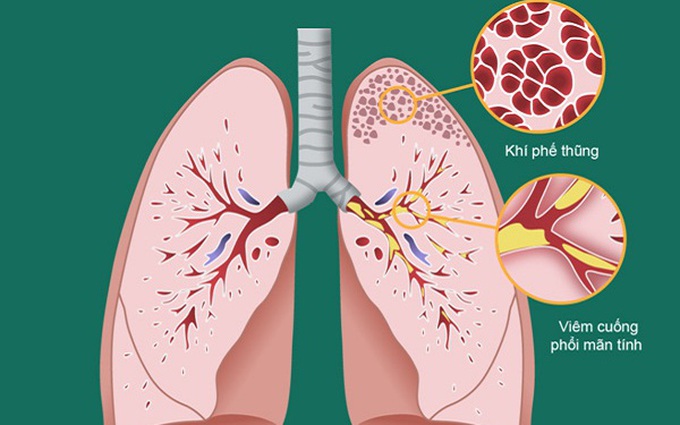 Những điều cần biết về phổi tắc nghẽn mãn tính giai đoạn 2, bắt đầu bộc phát ra bên ngoài cần đặc biệt cẩn thận!