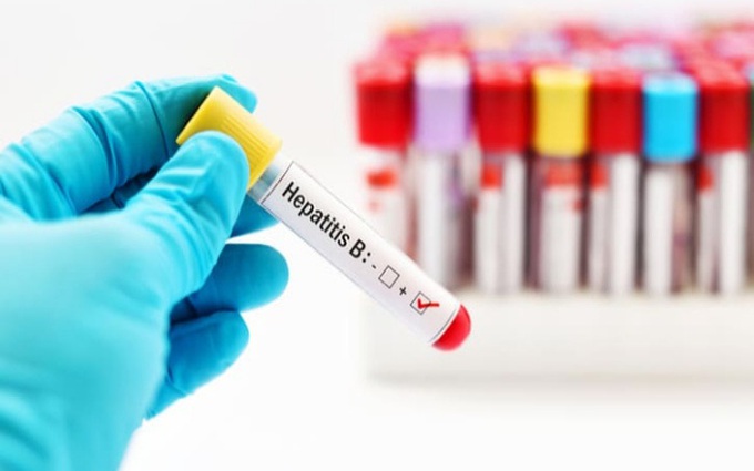 HBsAG là gì? Tổng quan về chỉ số HBsAG trong xét nghiệm viêm gan B