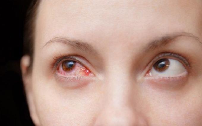 5 điều cần làm nếu nghi ngờ bị đau mắt đỏ, đặc biệt là điều số 3!