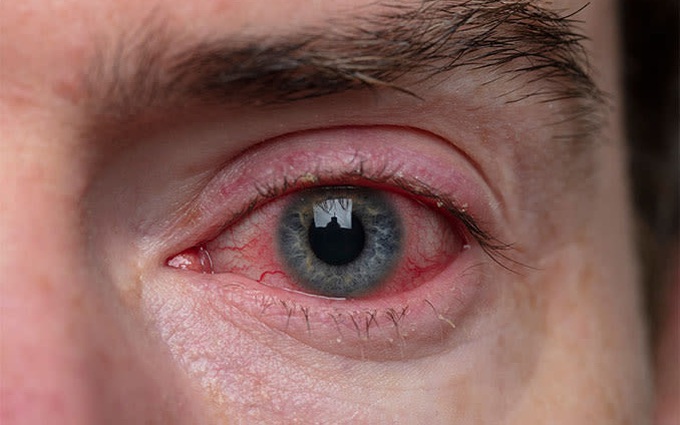 Bệnh viêm kết mạc kích ứng (đau mắt đỏ kích ứng) là gì? Những điều cần biết về viêm kết mạc kích ứng
