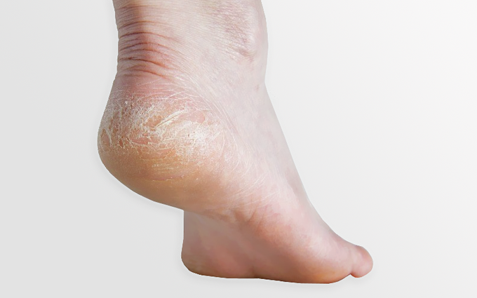 Nứt gót chân mùa hanh khô: Bệnh về da phổ biến nhưng không phải ai cũng biết cách đối phó