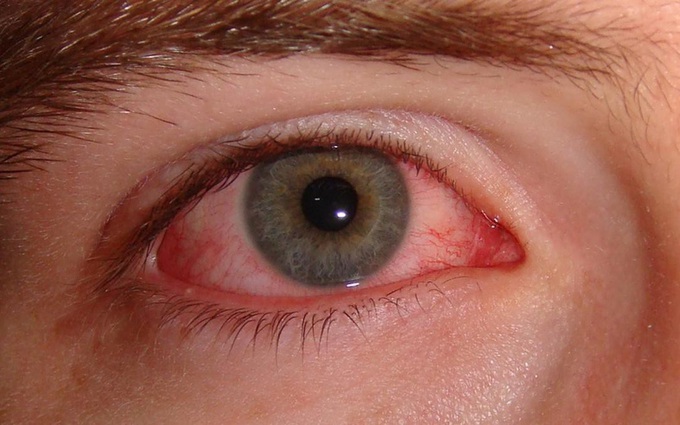 6 lưu ý cần nhớ khi điều trị đau mắt đỏ, đặc biệt là điều số 4!
