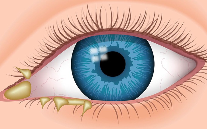 Mắt đổ ghèn là gì? Nguyên nhân và cách chữa mắt bé bị đổ ghèn