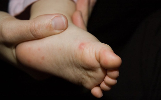 Chuyên gia y tế ‘mách’ cha mẹ cách tự kiểm tra bệnh tay chân miệng tại nhà cho trẻ cực đơn giản!