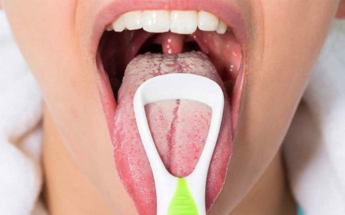 Lưỡi trắng là gì? Những điều cần biết về lưỡi trắng