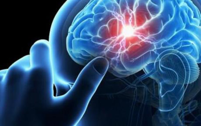 Tai biến mạch máu não là gì? Nguyên nhân và cách điều trị hiệu quả nhất