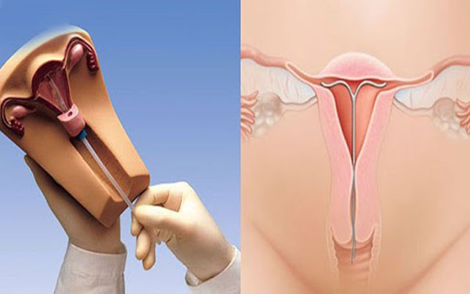 Đặt vòng tránh thai và các loại vòng tránh thai an toàn