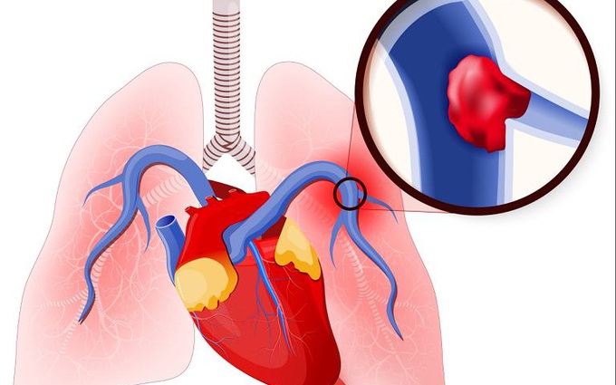 Những đối tượng có nguy cơ cao bị 'cục máu đông' gây nguy hiểm