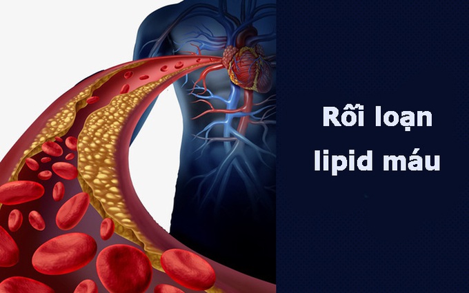 Rối loạn lipid máu là gì: Nguyên nhân, triệu chứng và chuẩn đoán điều trị như thế nào?