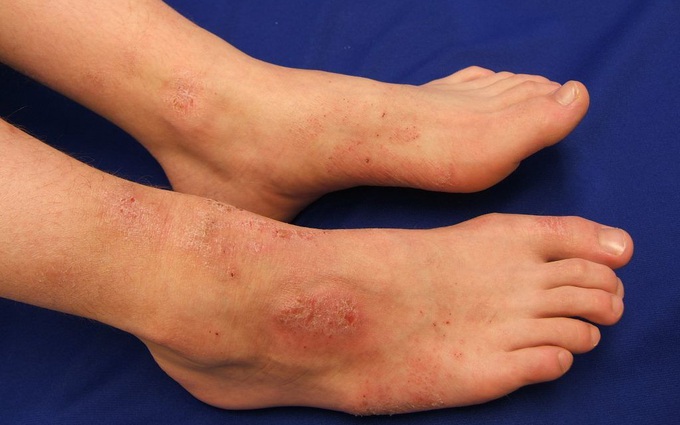 Các dạng viêm nhiễm da ở chân trong mùa mưa và cách phòng tránh