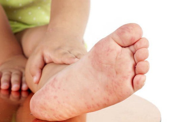 Bệnh tay chân miệng cấp độ 1 ở trẻ nhỏ: Biểu hiện, điều trị và phòng tránh
