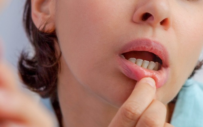 Nhiệt miệng liên tục xảy ra do đâu? Chế độ dinh dưỡng không phải nguyên nhân duy nhất gây nhiệt miệng
