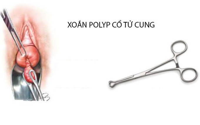 Quy trình thực hiện xoắn polyp cổ tử cung và những nữ giới cần biết