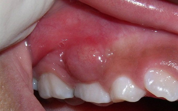 Thông tin từ A đến Z về hiện tượng mọc mụn ở nướu răng