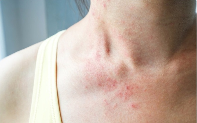 Những triệu chứng trên da của bệnh nhân Covid-19 có thể bạn chưa biết